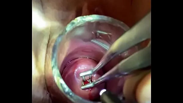 Tonton Bakes dilator enters through endocervical speculum Tube baru